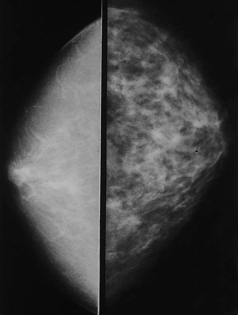 I am 43 and had my 2nd mammogram this past week. . Breast focal asymmetry reddit